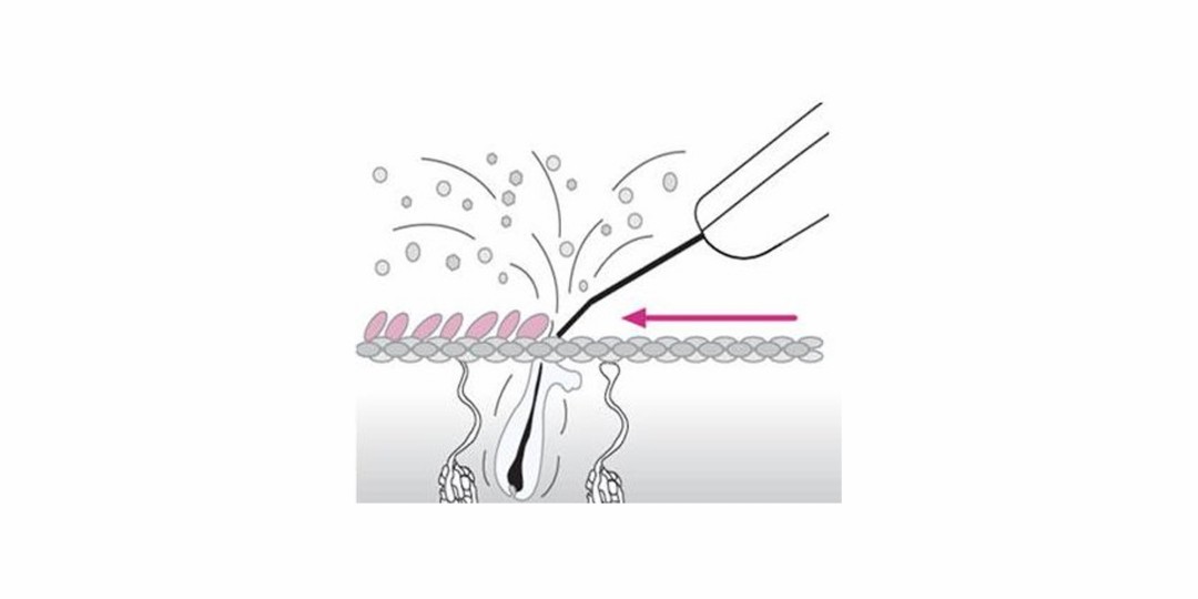 Здоровье: Ультразвуковая чистка кожи Испания | Команда Uehat.com | Блог ...